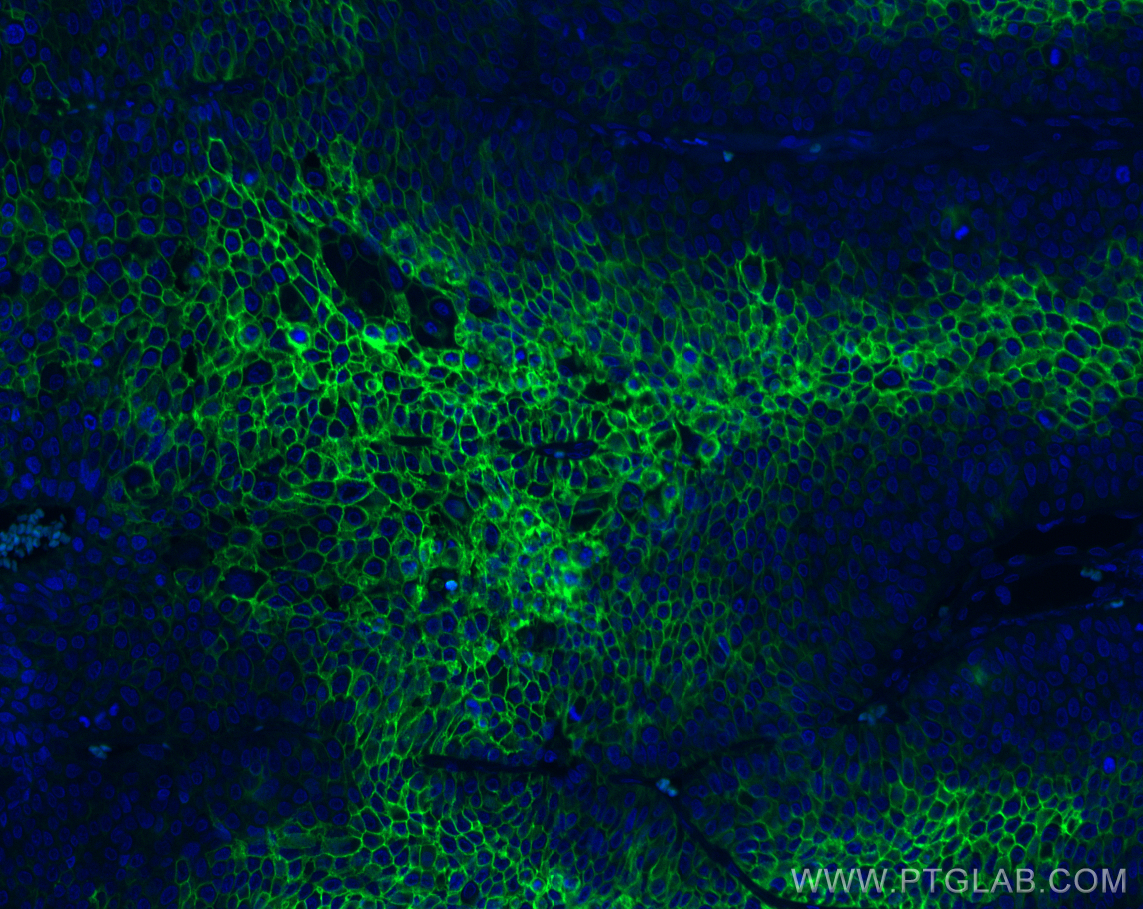 Immunofluorescence (IF) / fluorescent staining of human lung cancer tissue using CoraLite® Plus 488-conjugated GLUT1 Monoclonal ant (CL488-66290)