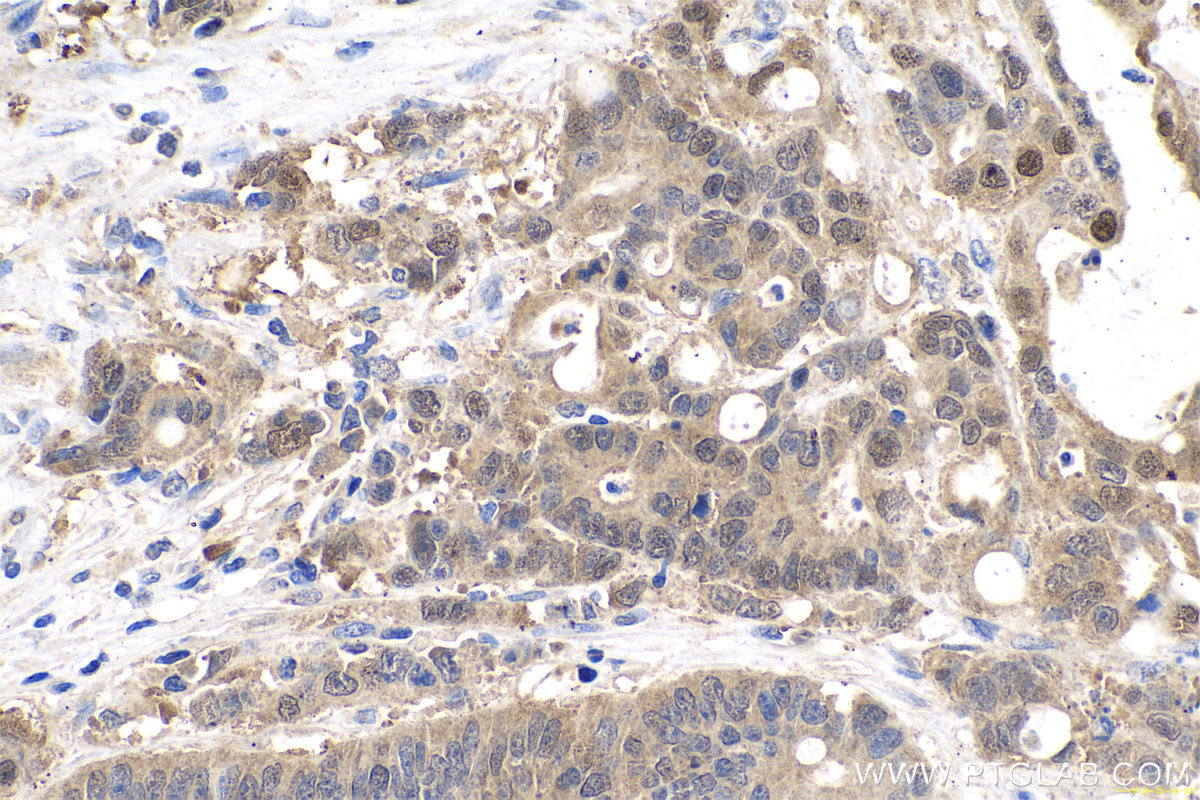 Immunohistochemistry (IHC) staining of human colon cancer tissue using GMDS Polyclonal antibody (15442-1-AP)