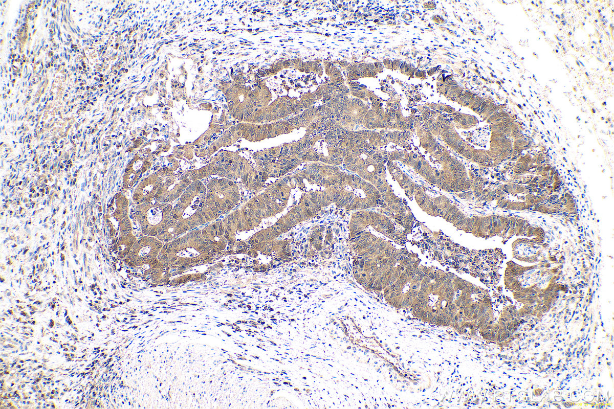 Immunohistochemistry (IHC) staining of human colon cancer tissue using GMDS Polyclonal antibody (15442-1-AP)