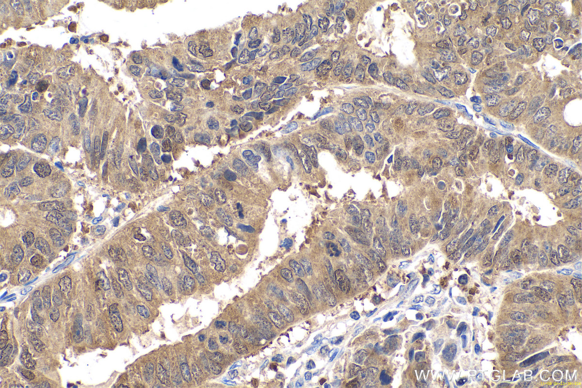 Immunohistochemistry (IHC) staining of human colon cancer tissue using GMDS Polyclonal antibody (15442-1-AP)