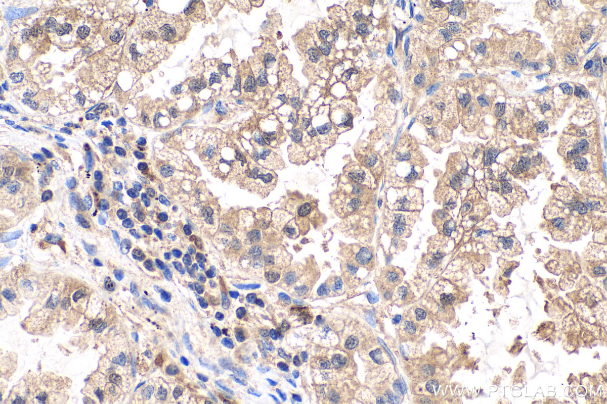 Immunohistochemistry (IHC) staining of human lung cancer tissue using GMDS Polyclonal antibody (15442-1-AP)