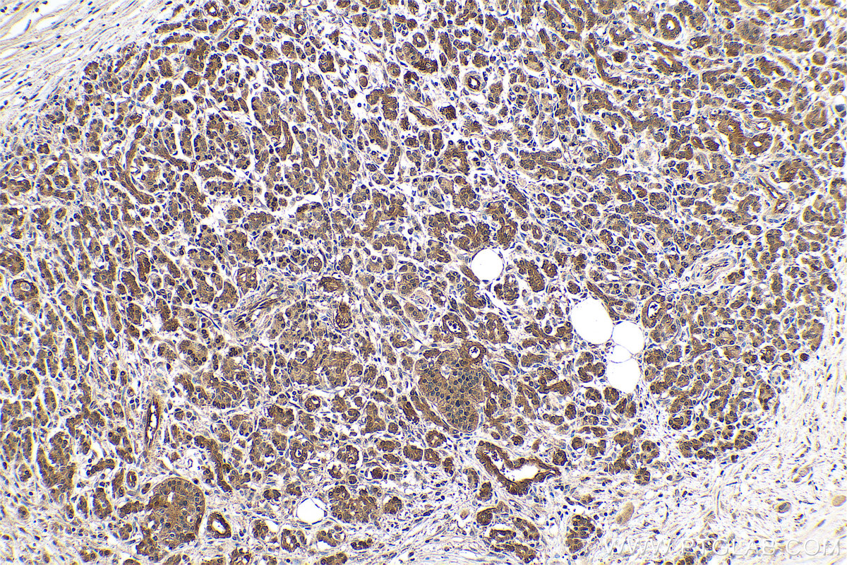 Immunohistochemistry (IHC) staining of human pancreas cancer tissue using GMDS Polyclonal antibody (15442-1-AP)