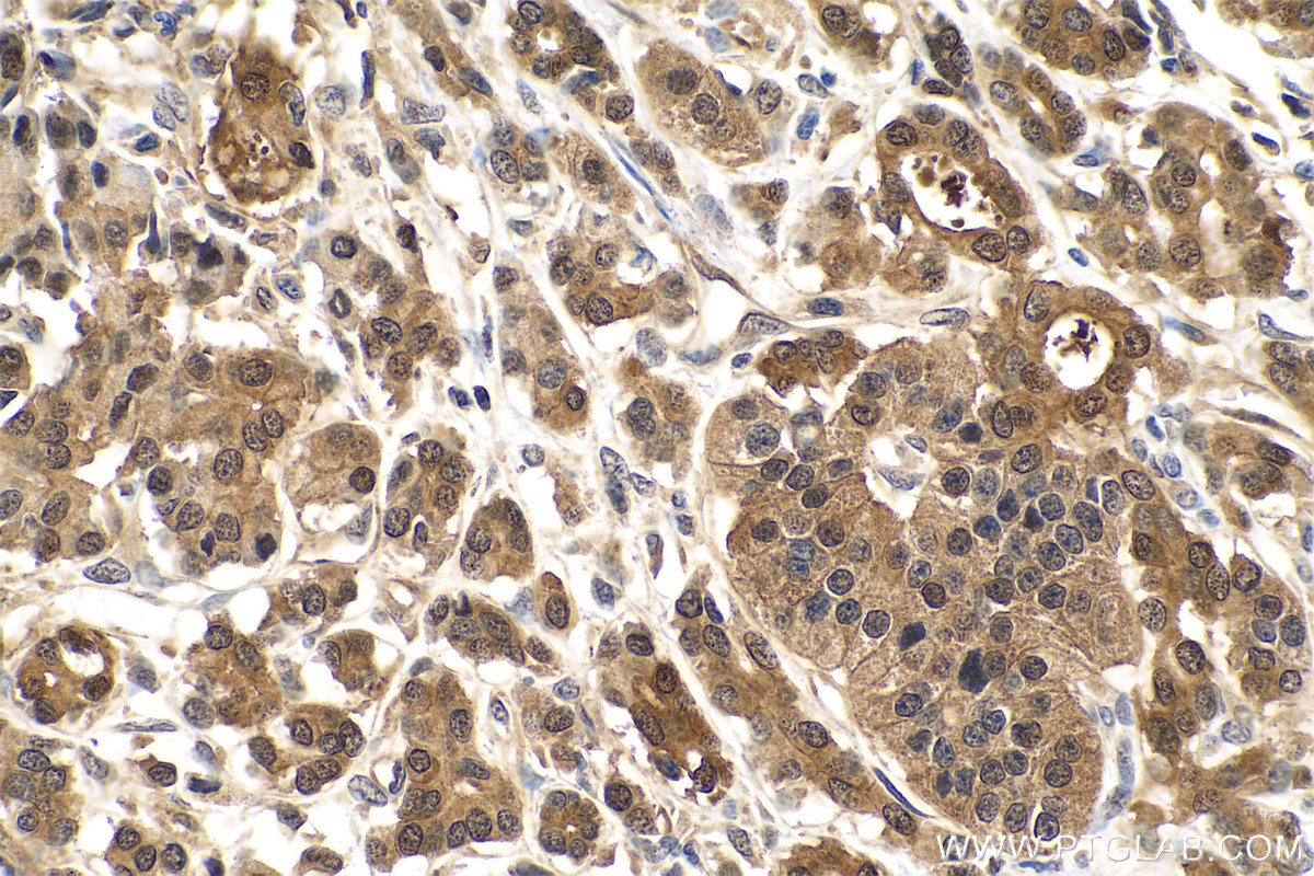 Immunohistochemistry (IHC) staining of human pancreas cancer tissue using GMDS Polyclonal antibody (15442-1-AP)