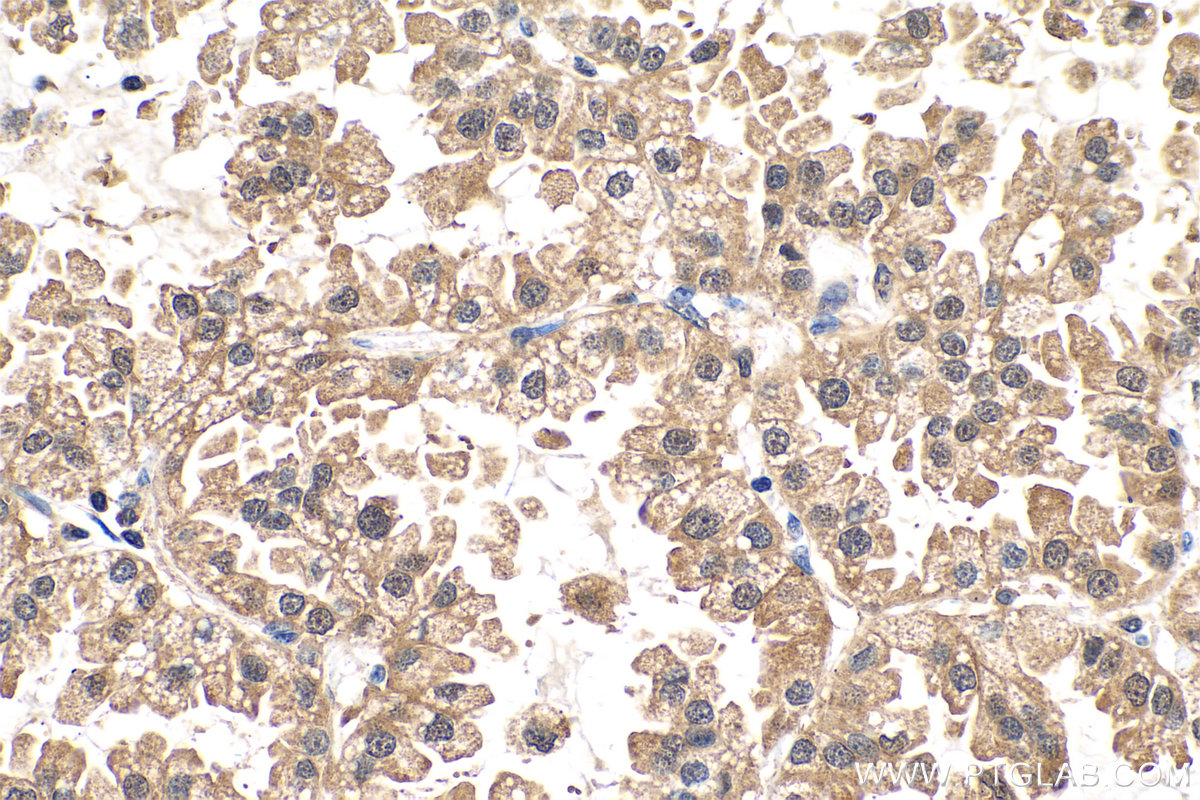 Immunohistochemistry (IHC) staining of human lung cancer tissue using GMDS Polyclonal antibody (15442-1-AP)