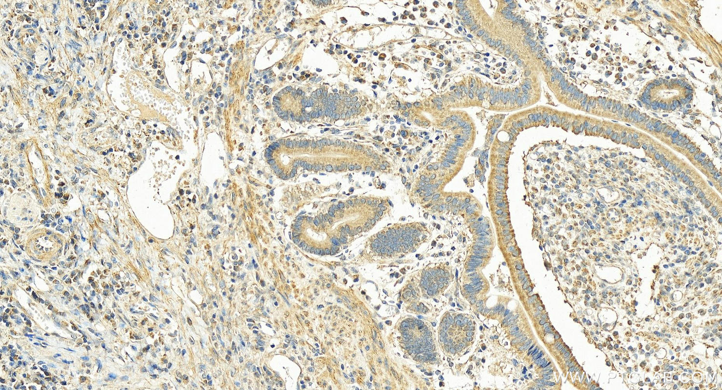 Immunohistochemistry (IHC) staining of human stomach cancer tissue using GMIP Polyclonal antibody (25917-1-AP)