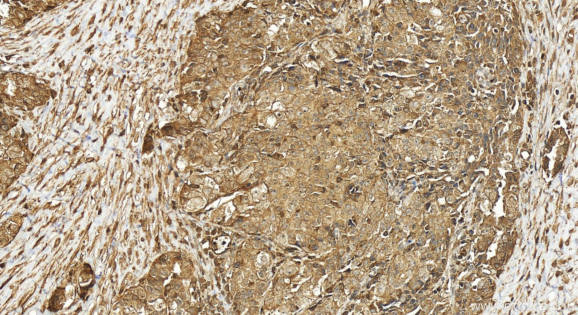 Immunohistochemistry (IHC) staining of human ovary cancer tissue using GMIP Polyclonal antibody (25917-1-AP)