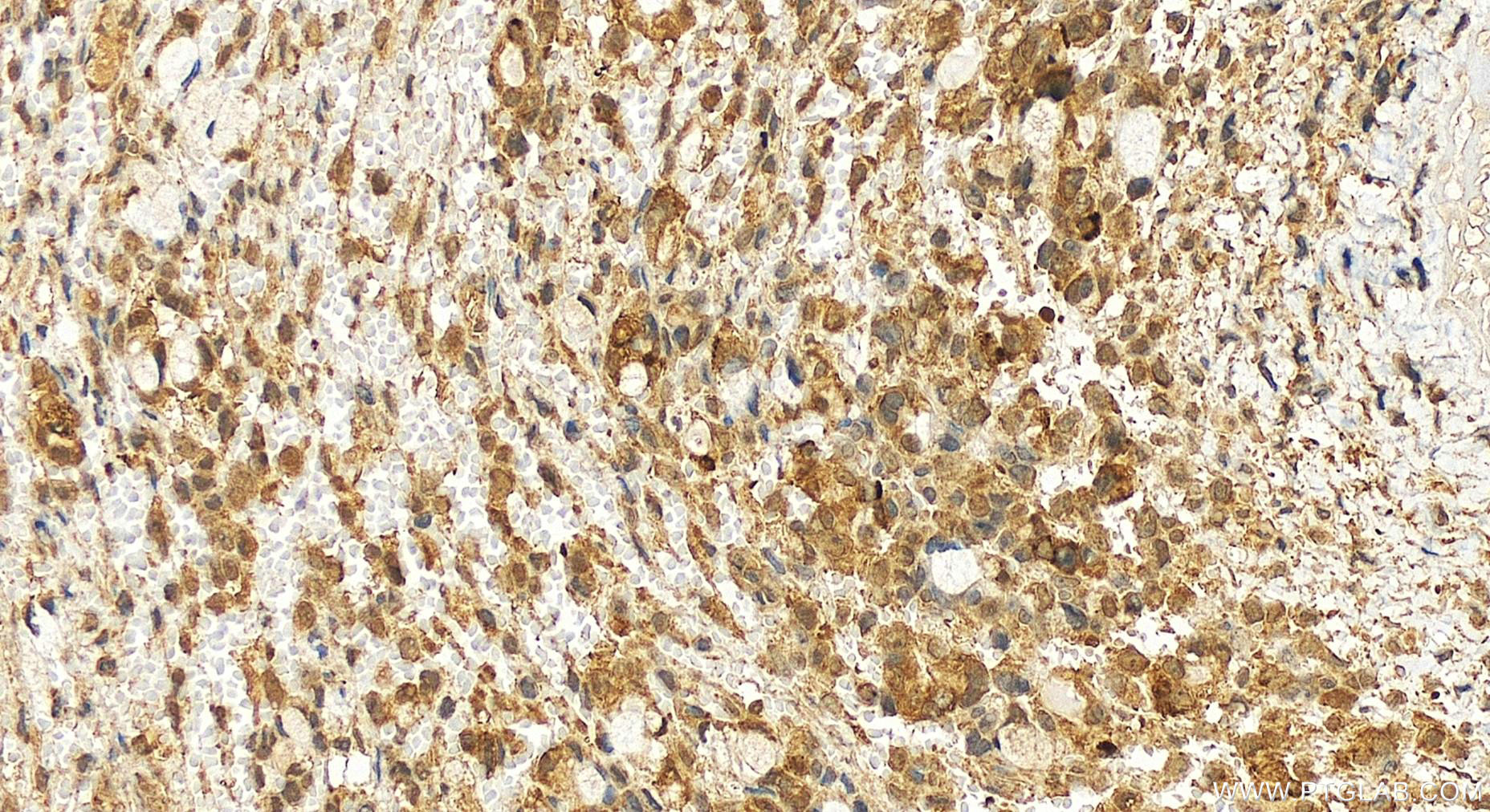 Immunohistochemistry (IHC) staining of human ovary cancer tissue using GMPPB Polyclonal antibody (15094-1-AP)