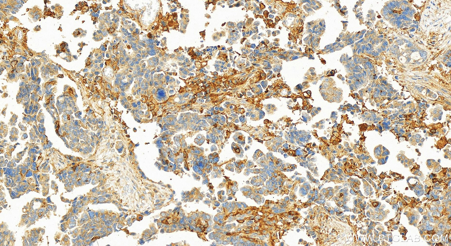 Immunohistochemistry (IHC) staining of human ovary cancer tissue using GNAI2 Polyclonal antibody (11136-1-AP)