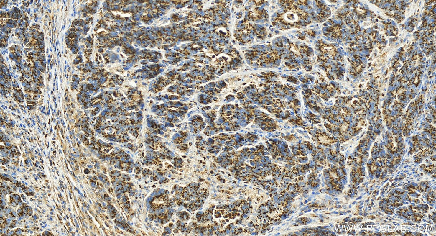 Immunohistochemistry (IHC) staining of human stomach cancer tissue using GP73/GOLPH2 Polyclonal antibody (15126-1-AP)