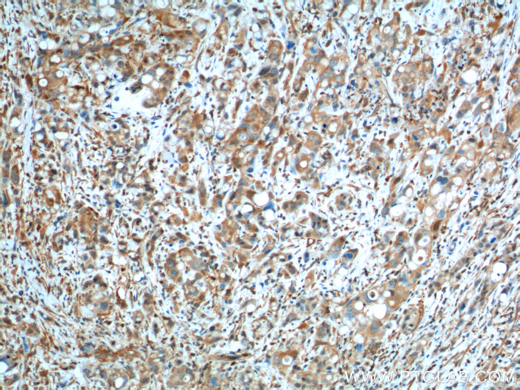 Immunohistochemistry (IHC) staining of human liver cancer tissue using GOT1 Monoclonal antibody (60317-1-Ig)