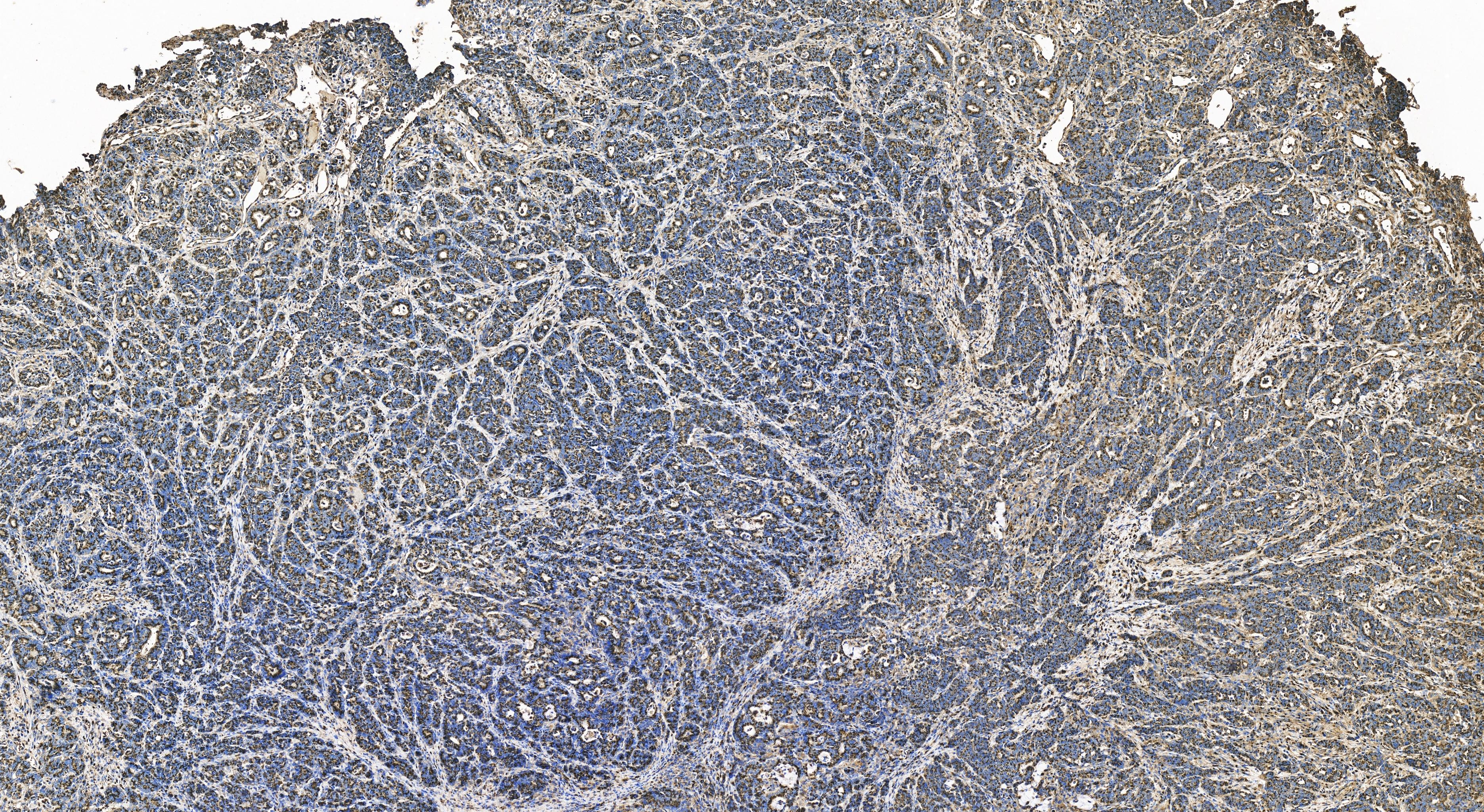 Immunohistochemistry (IHC) staining of human stomach cancer tissue using GP73/GOLPH2 Recombinant antibody (81893-1-RR)