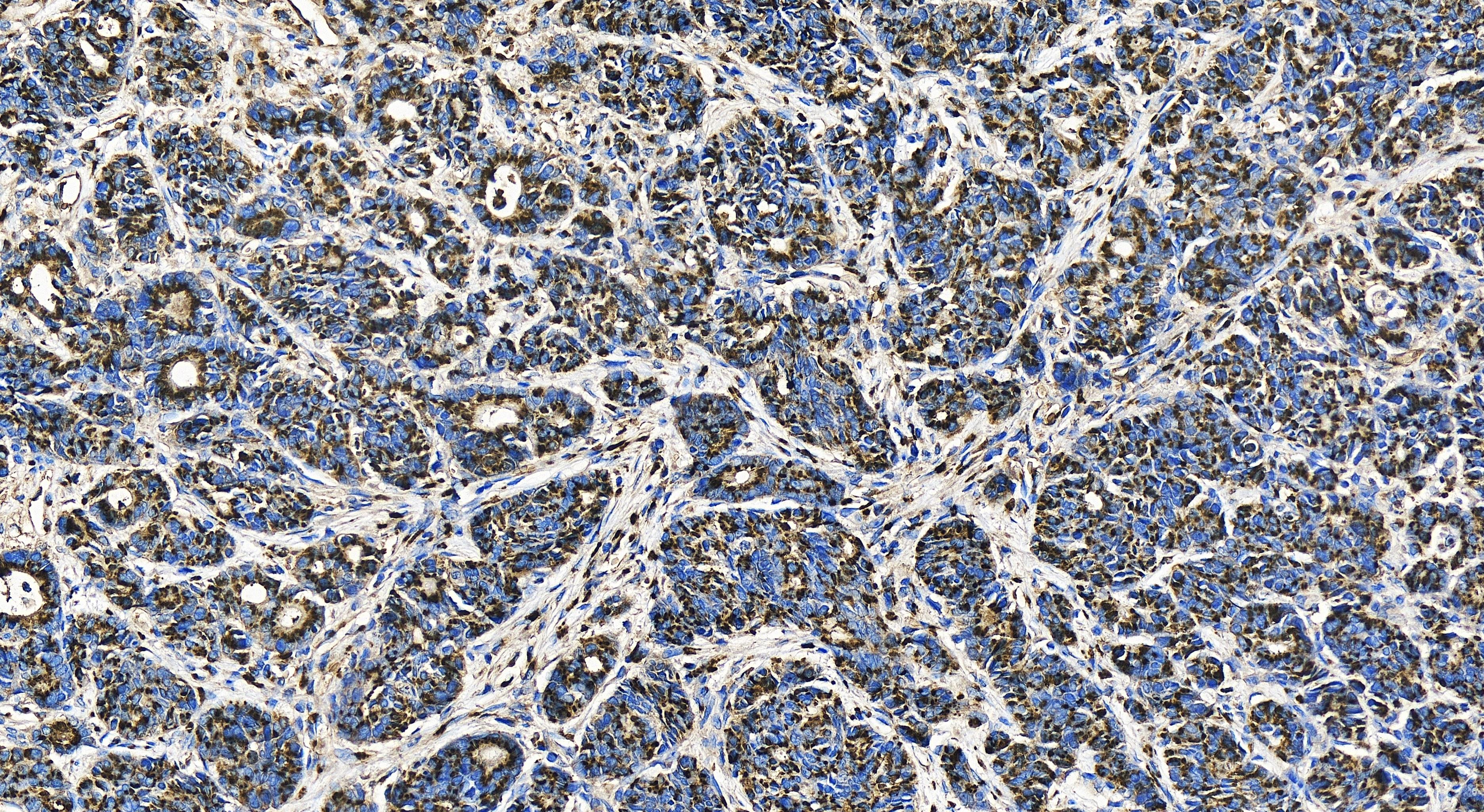 Immunohistochemistry (IHC) staining of human stomach cancer tissue using GP73/GOLPH2 Recombinant antibody (81893-1-RR)