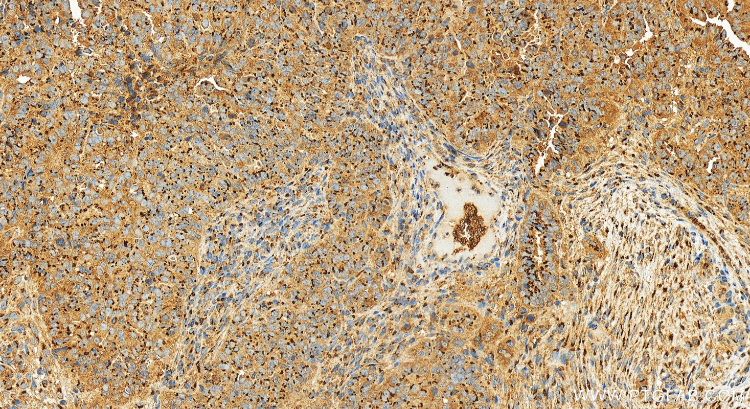 Immunohistochemistry (IHC) staining of human ovarian  cancer using GP73/GOLPH2 Recombinant antibody (81893-1-RR)