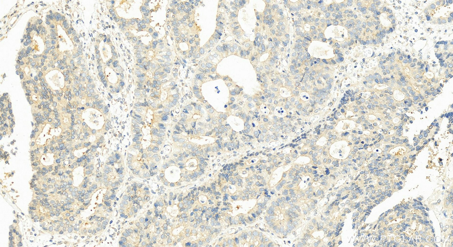 Immunohistochemistry (IHC) staining of human stomach cancer tissue using GPR35 Polyclonal antibody (55248-1-AP)