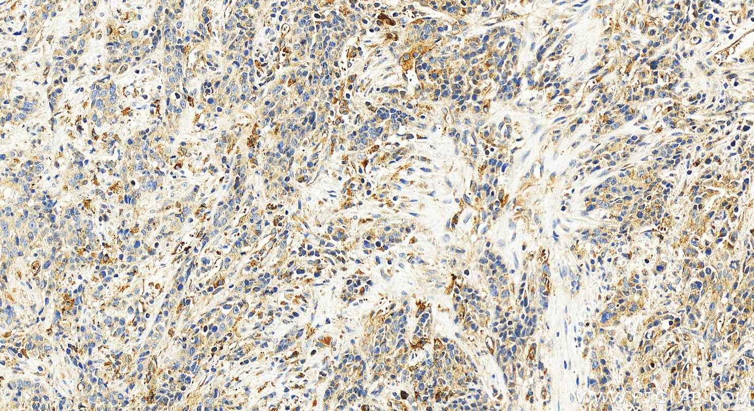 Immunohistochemistry (IHC) staining of human stomach cancer tissue using GPR35 Polyclonal antibody (55248-1-AP)