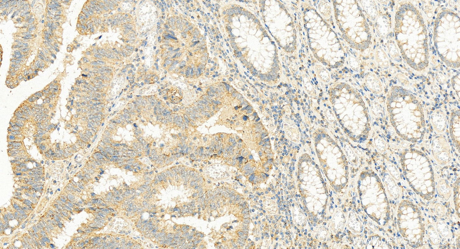 Immunohistochemistry (IHC) staining of human colon cancer tissue using GPRC5A,RAI3 Polyclonal antibody (10309-1-AP)