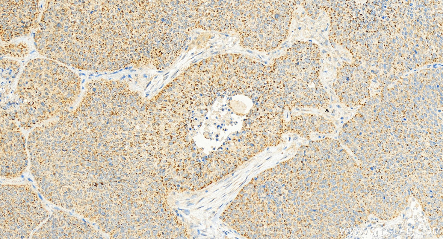 Immunohistochemistry (IHC) staining of human lung squamous cell carcinoma tissue using GPRC5A,RAI3 Polyclonal antibody (10309-1-AP)