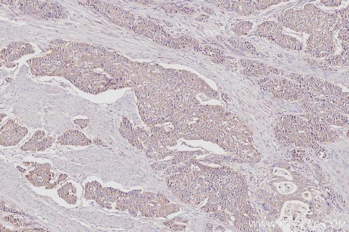 Immunohistochemistry (IHC) staining of human stomach cancer tissue using GRASP65,GORASP1 Polyclonal antibody (10747-2-AP)