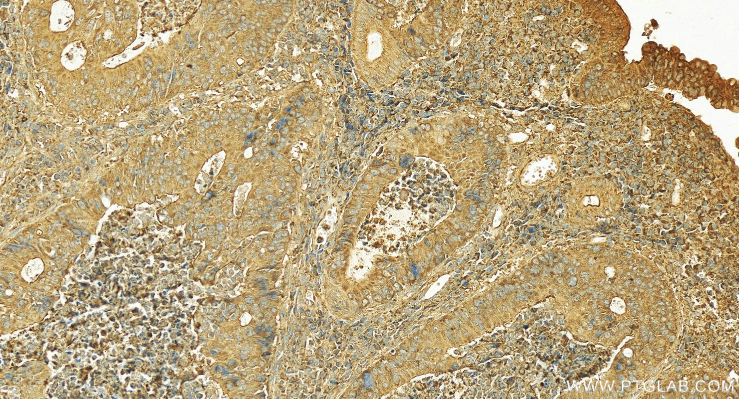 Immunohistochemistry (IHC) staining of Human colon cancer tissue using GRM8 Polyclonal antibody (18224-1-AP)