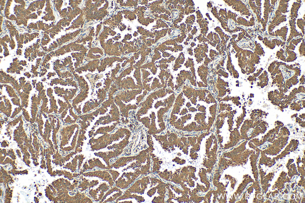 Immunohistochemistry (IHC) staining of human lung cancer tissue using GRP94 Recombinant antibody (83147-5-RR)