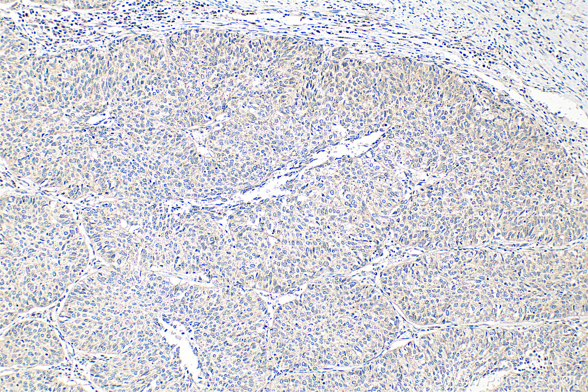 Immunohistochemistry (IHC) staining of human cervical cancer tissue using BET1L Polyclonal antibody (14163-1-AP)