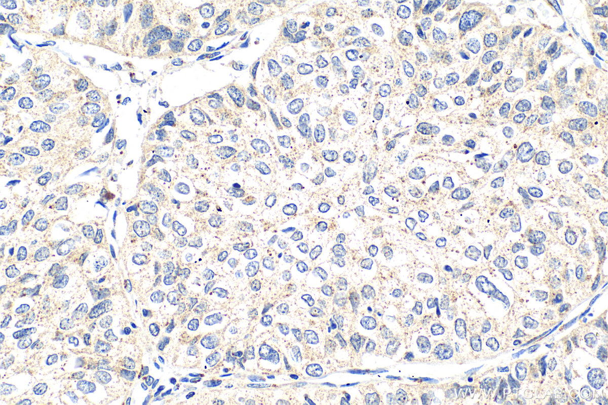 Immunohistochemistry (IHC) staining of human cervical cancer tissue using BET1L Polyclonal antibody (14163-1-AP)