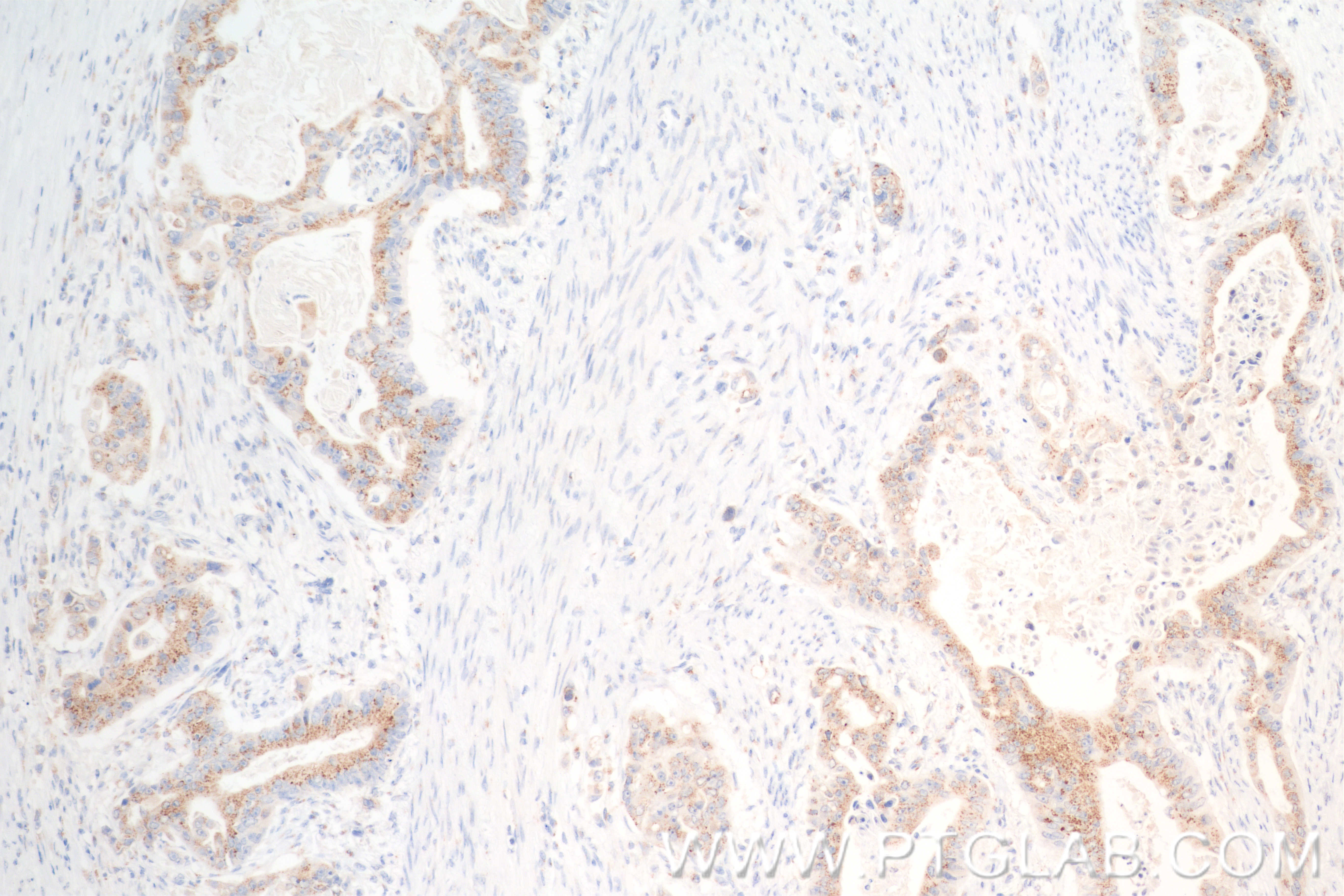 Immunohistochemistry (IHC) staining of human stomach cancer tissue using GS28 Recombinant antibody (84971-3-RR)