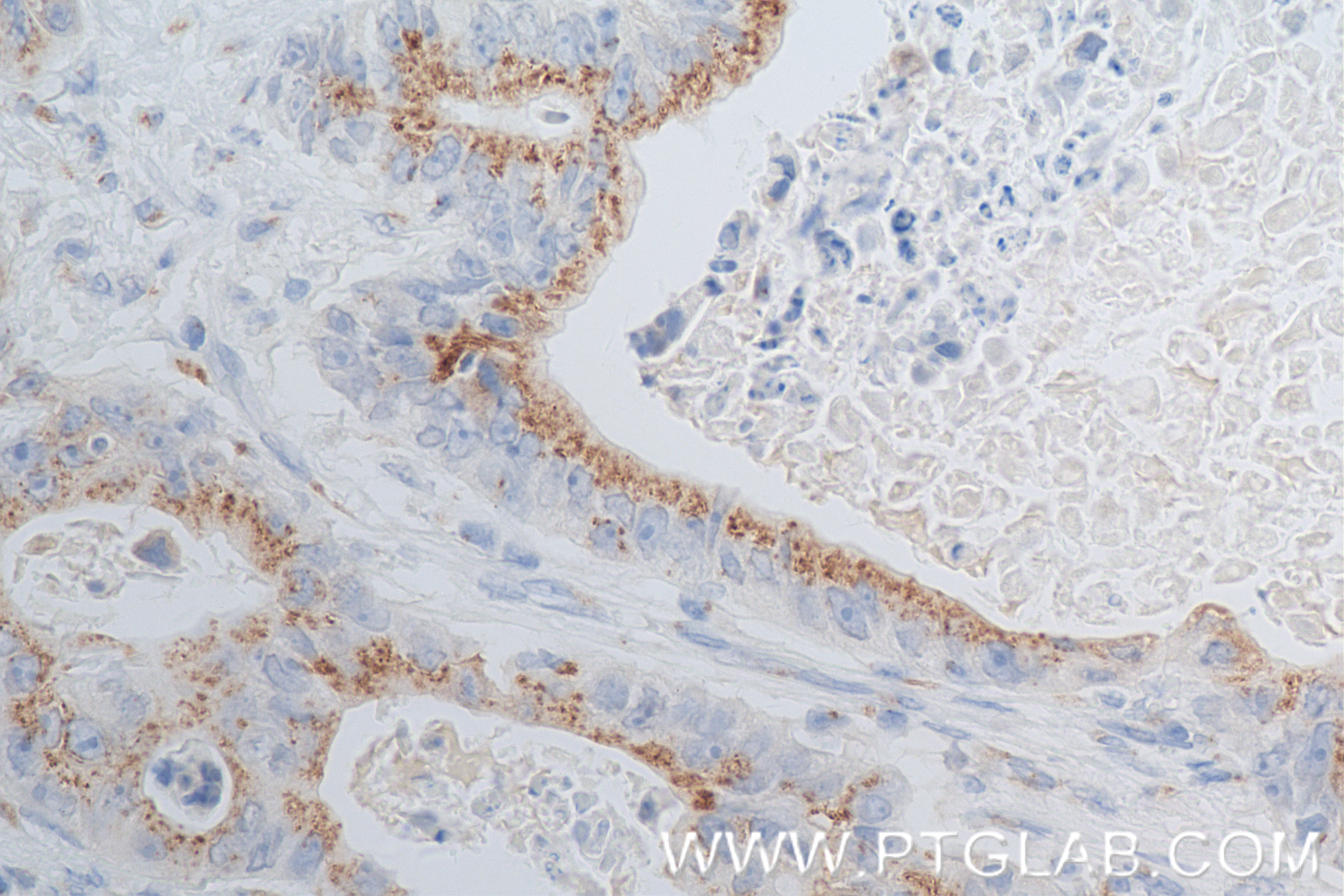 Immunohistochemistry (IHC) staining of human stomach cancer tissue using GS28 Recombinant antibody (84971-3-RR)