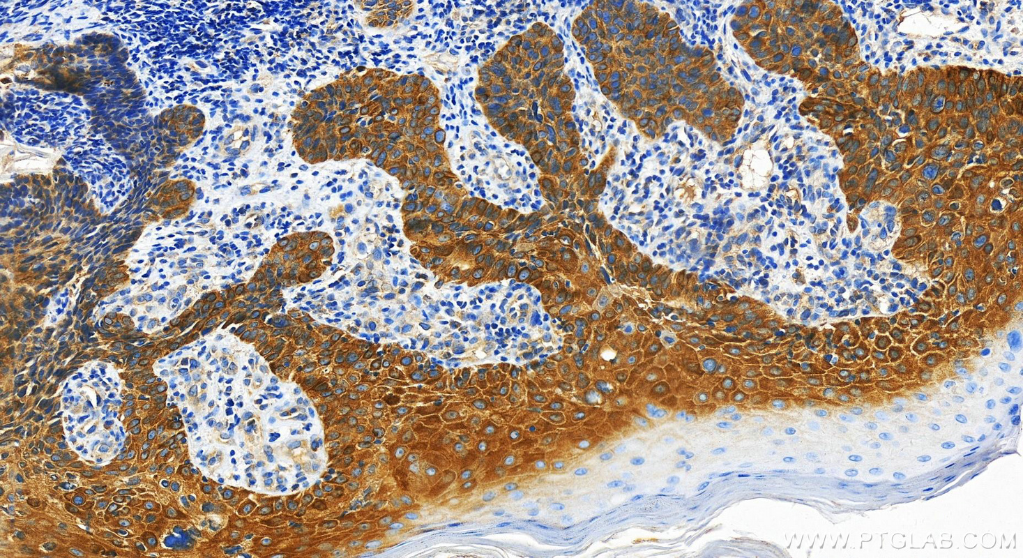 Immunohistochemistry (IHC) staining of Human bowens disease using GSDMC Polyclonal antibody (30469-1-AP)