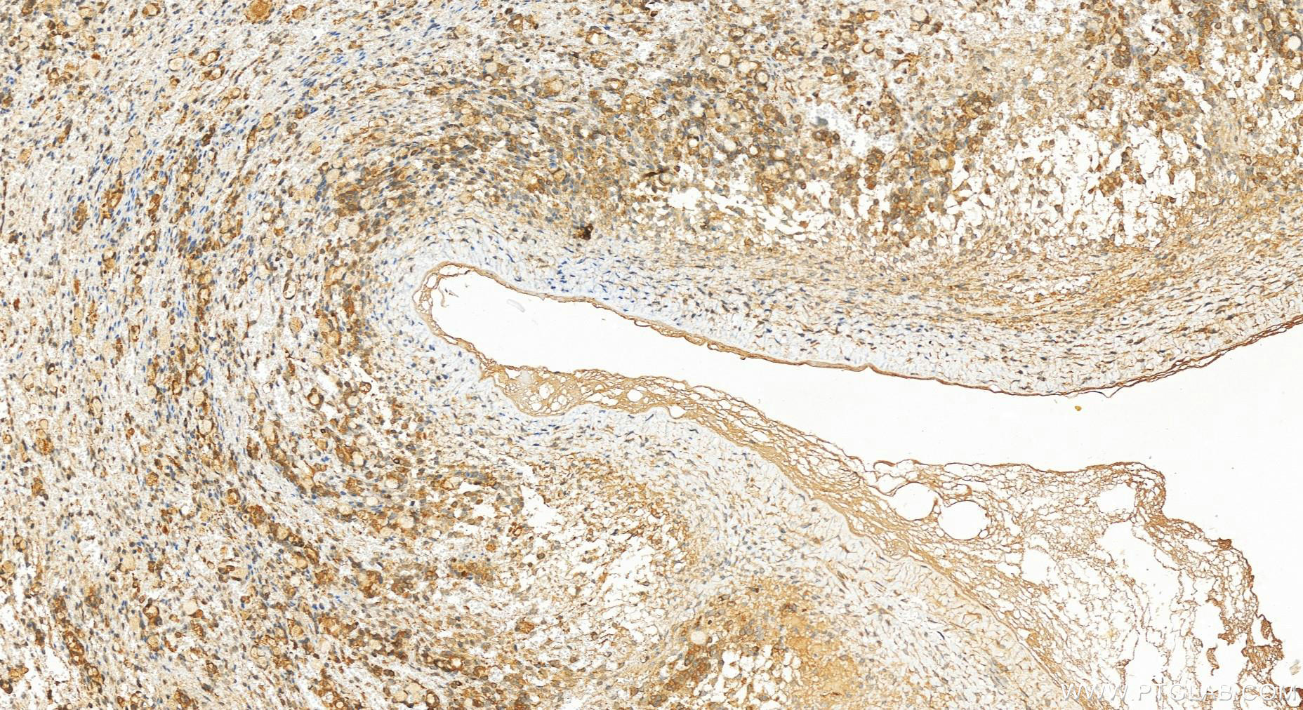 Immunohistochemistry (IHC) staining of human ovary cancer tissue using GSDMD  Polyclonal antibody (20770-1-AP)