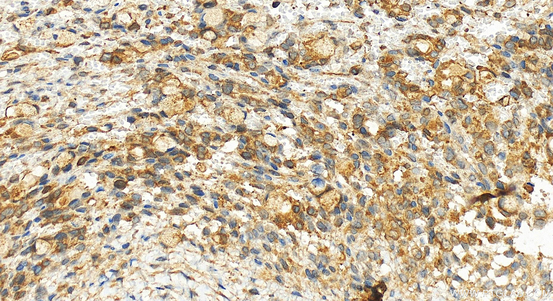 Immunohistochemistry (IHC) staining of human ovary cancer tissue using GSDMD  Polyclonal antibody (20770-1-AP)