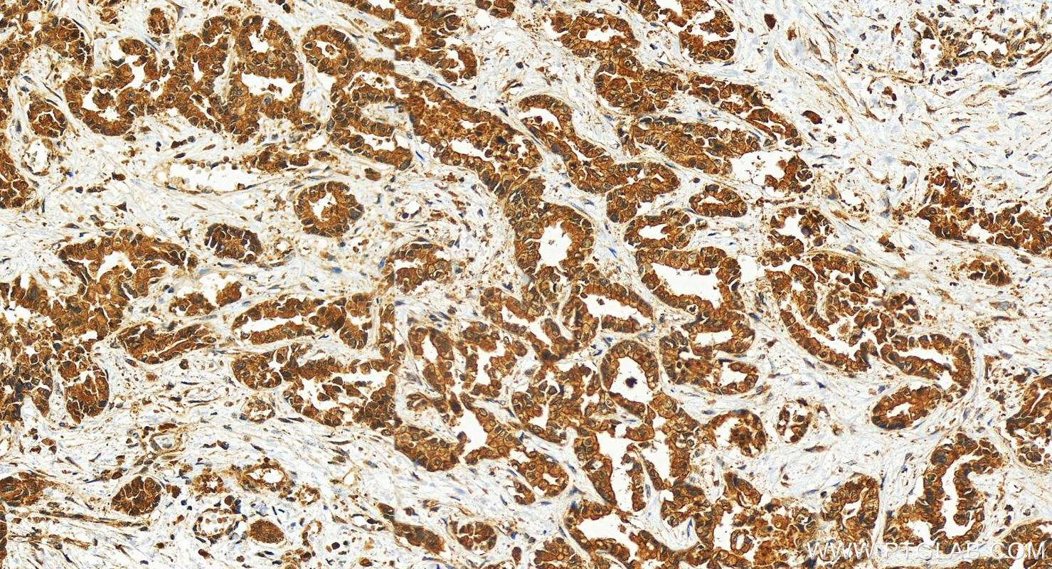 Immunohistochemistry (IHC) staining of human intrahepatic cholangiocarcinoma tissue using GSDMD Polyclonal antibody (30531-1-AP)