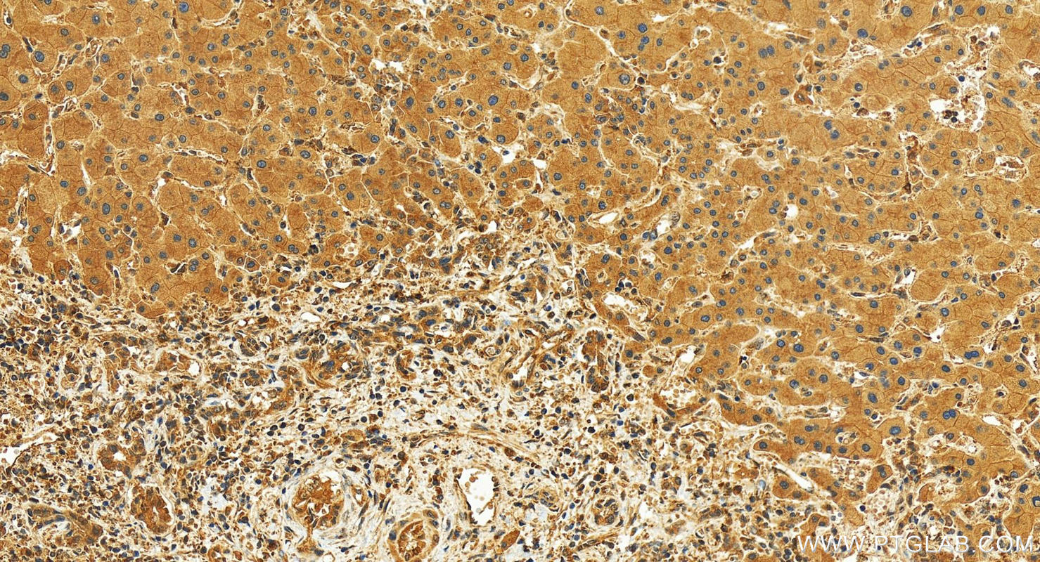 Immunohistochemistry (IHC) staining of human intrahepatic cholangiocarcinoma tissue using GSDMD Polyclonal antibody (30531-1-AP)