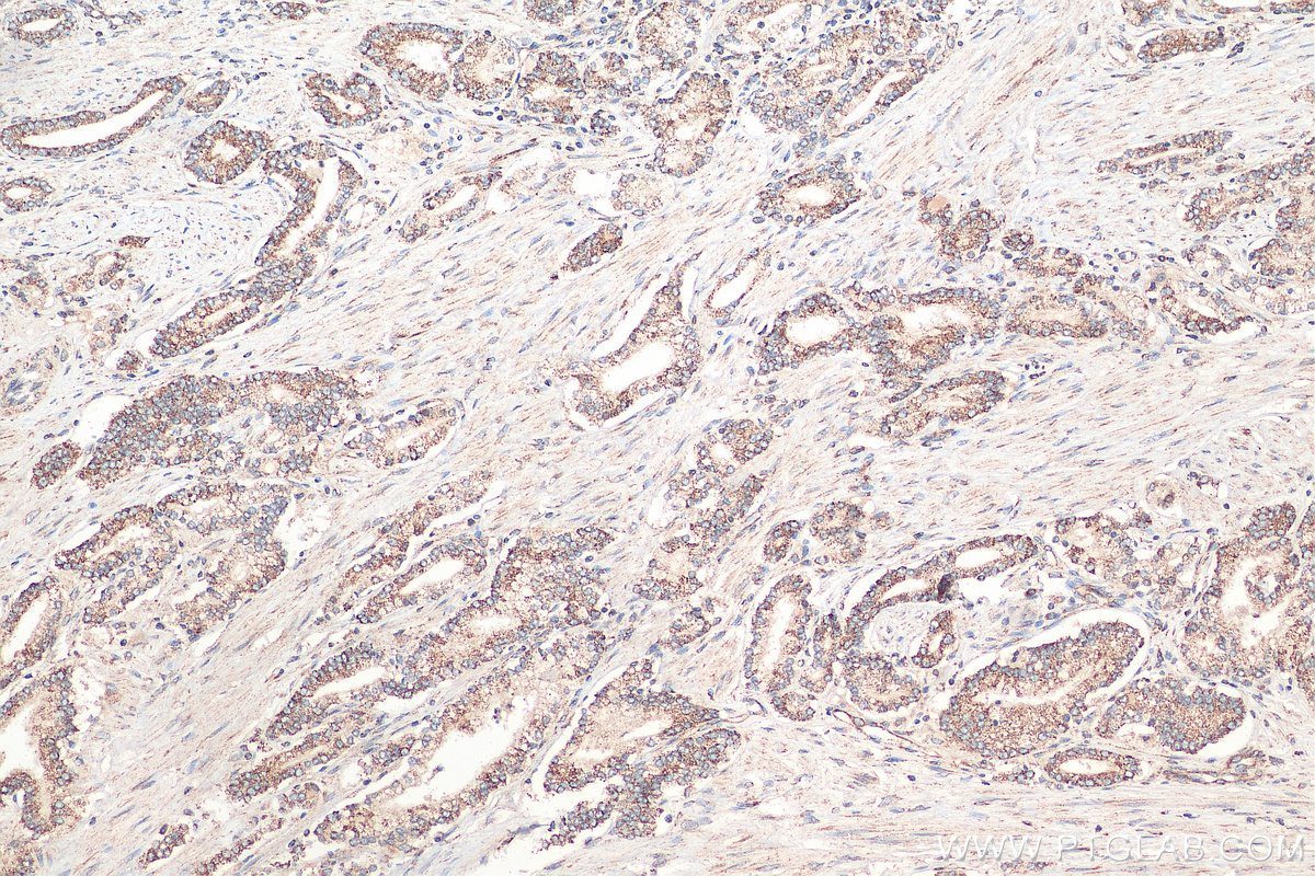 Immunohistochemistry (IHC) staining of human prostate cancer tissue using GSK3A Polyclonal antibody (13419-1-AP)