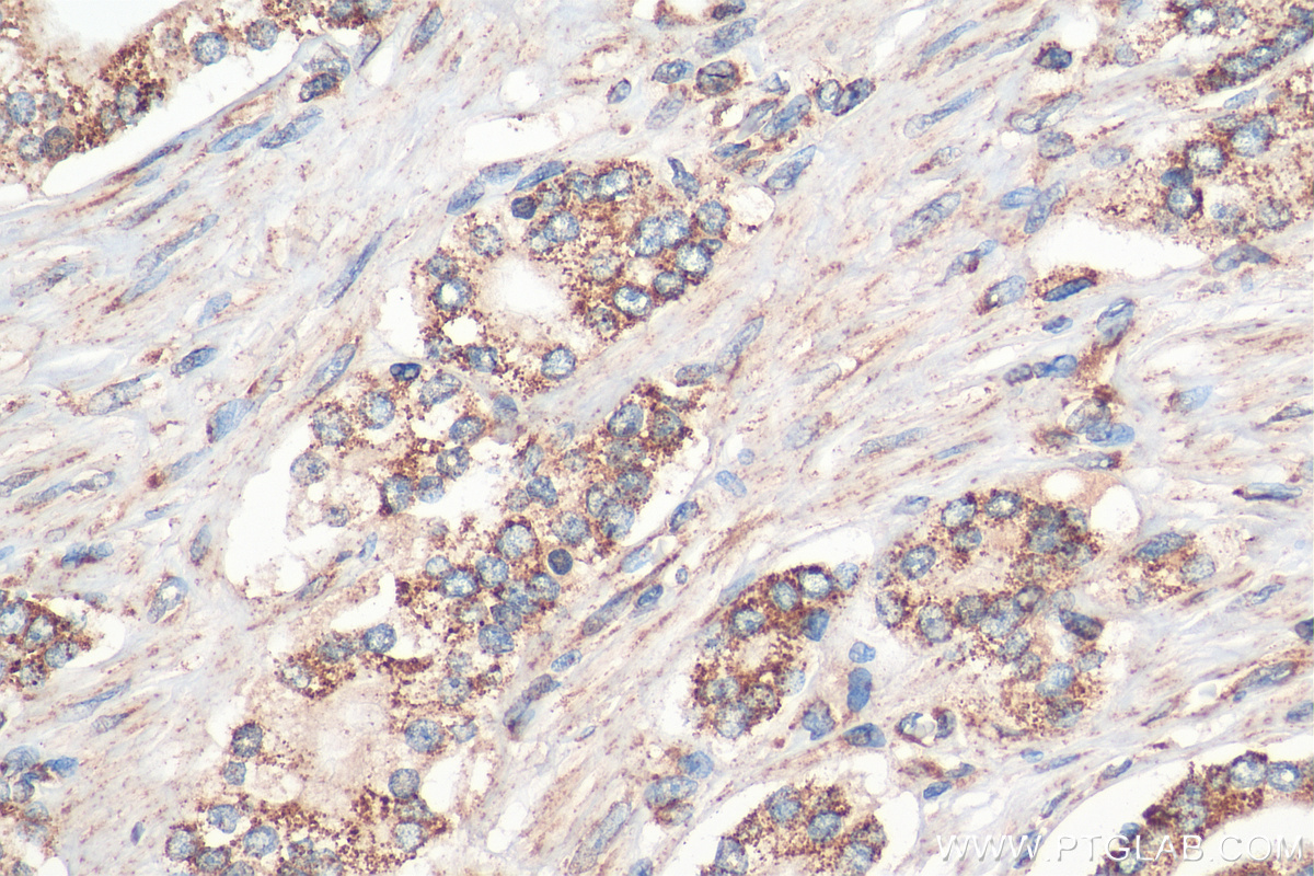 Immunohistochemistry (IHC) staining of human prostate cancer tissue using GSK3A Polyclonal antibody (13419-1-AP)