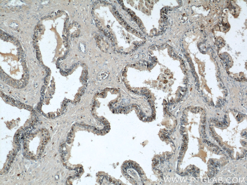 IHC staining of paraffinembedded human prostate hyperplasia using GSK3B antibody (22104-1-AP) at a dilution of 1:50 (10x objective)