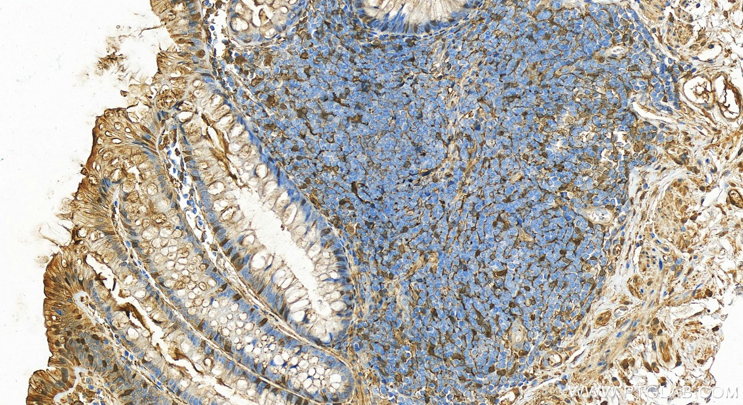 Immunohistochemistry (IHC) staining of human colon tissue using Gelsolin Polyclonal antibody (11644-2-AP)