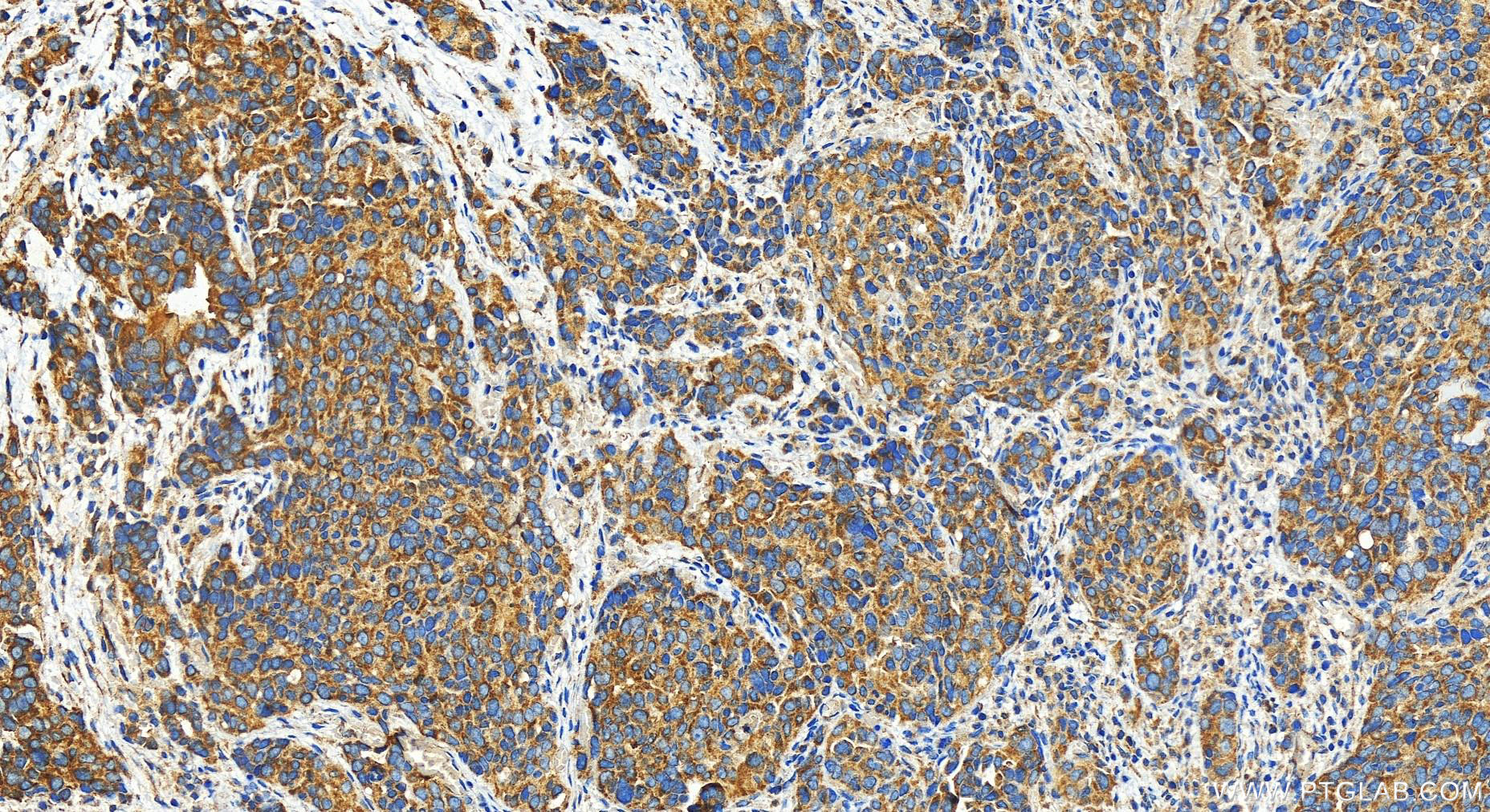 Immunohistochemistry (IHC) staining of human ovary cancer tissue using eRF3a/GSPT1 Polyclonal antibody (28130-1-AP)