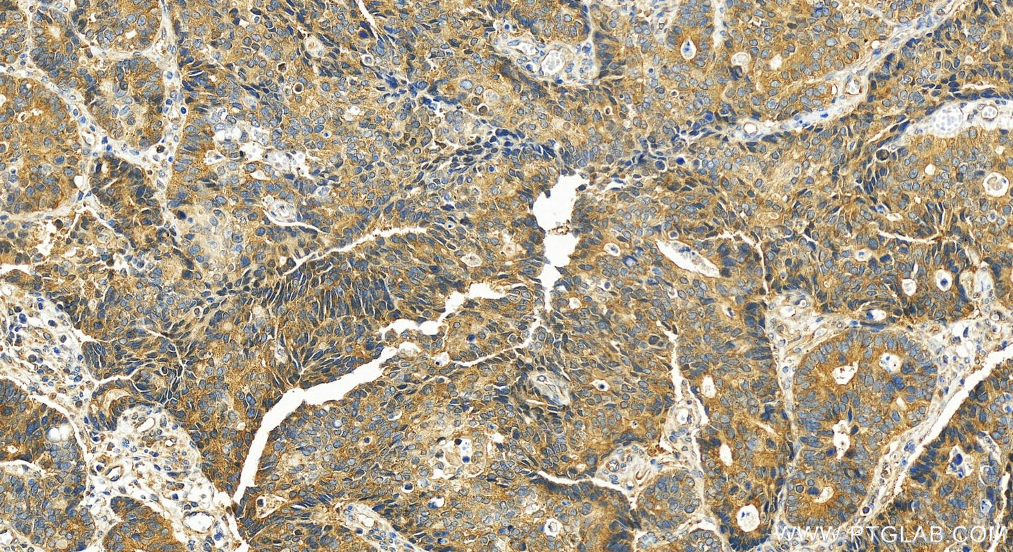 Immunohistochemistry (IHC) staining of human stomach cancer tissue using GSTM2 Polyclonal antibody (55474-1-AP)