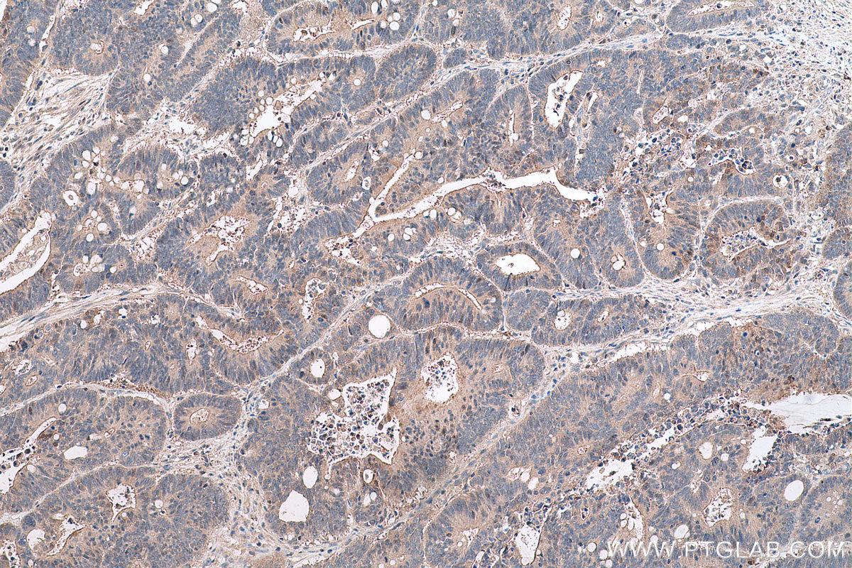 Immunohistochemistry (IHC) staining of human colon cancer tissue using GSTM4 Polyclonal antibody (16766-1-AP)