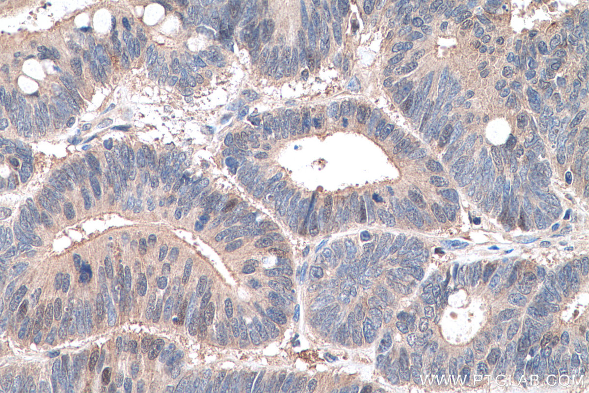 Immunohistochemistry (IHC) staining of human colon cancer tissue using GSTM4 Polyclonal antibody (16766-1-AP)