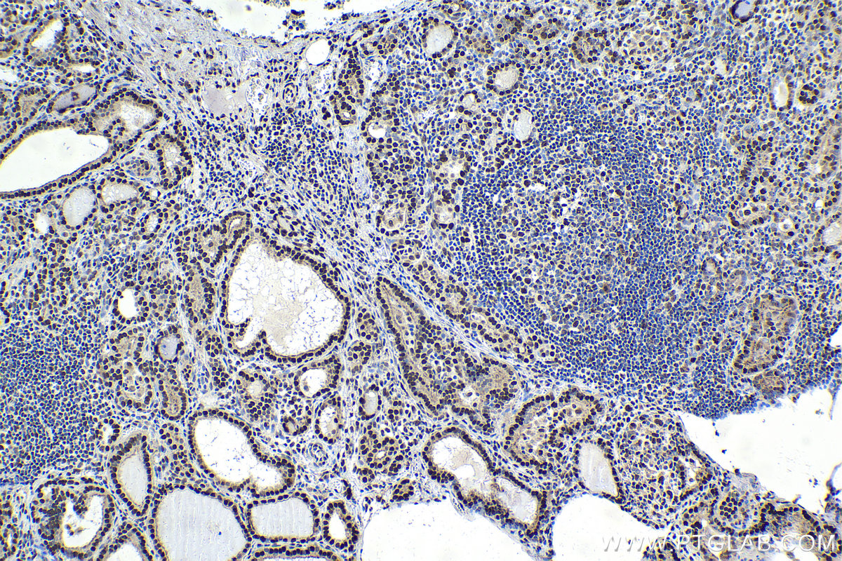 Immunohistochemistry (IHC) staining of human thyroid cancer tissue using TFII I Polyclonal antibody (10499-1-AP)