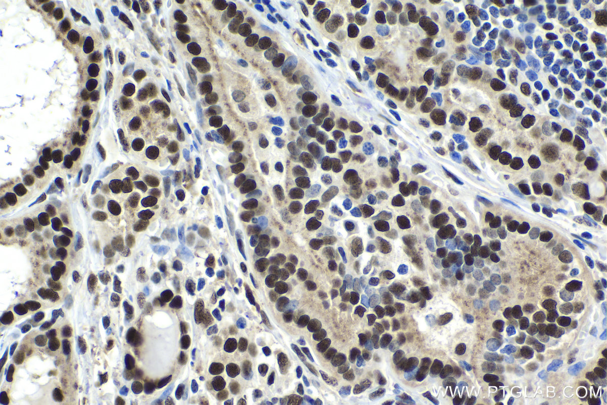 Immunohistochemistry (IHC) staining of human thyroid cancer tissue using TFII I Polyclonal antibody (10499-1-AP)