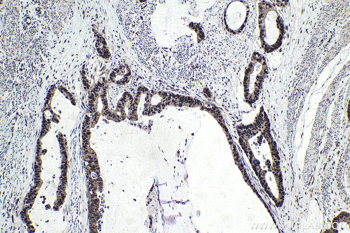 Immunohistochemistry (IHC) staining of human urothelial carcinoma tissue using TFII I Polyclonal antibody (10499-1-AP)