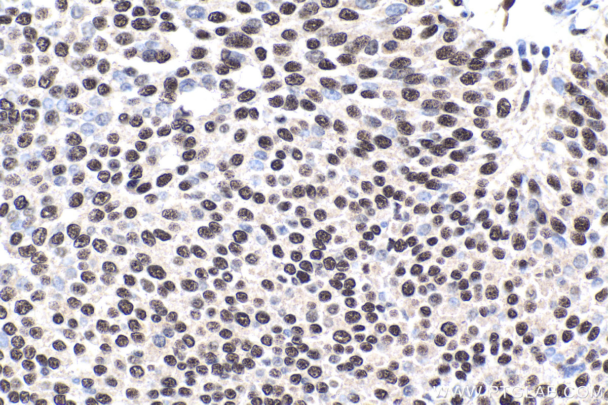 Immunohistochemistry (IHC) staining of human urothelial carcinoma tissue using GTF3C6 Polyclonal antibody (26382-1-AP)