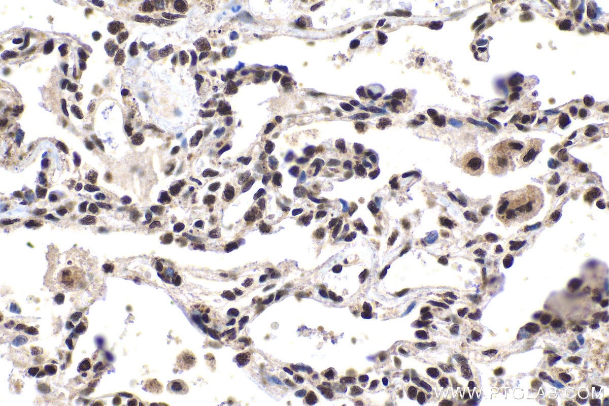 Immunohistochemistry (IHC) staining of human lung cancer tissue using GTF3C6 Polyclonal antibody (26382-1-AP)