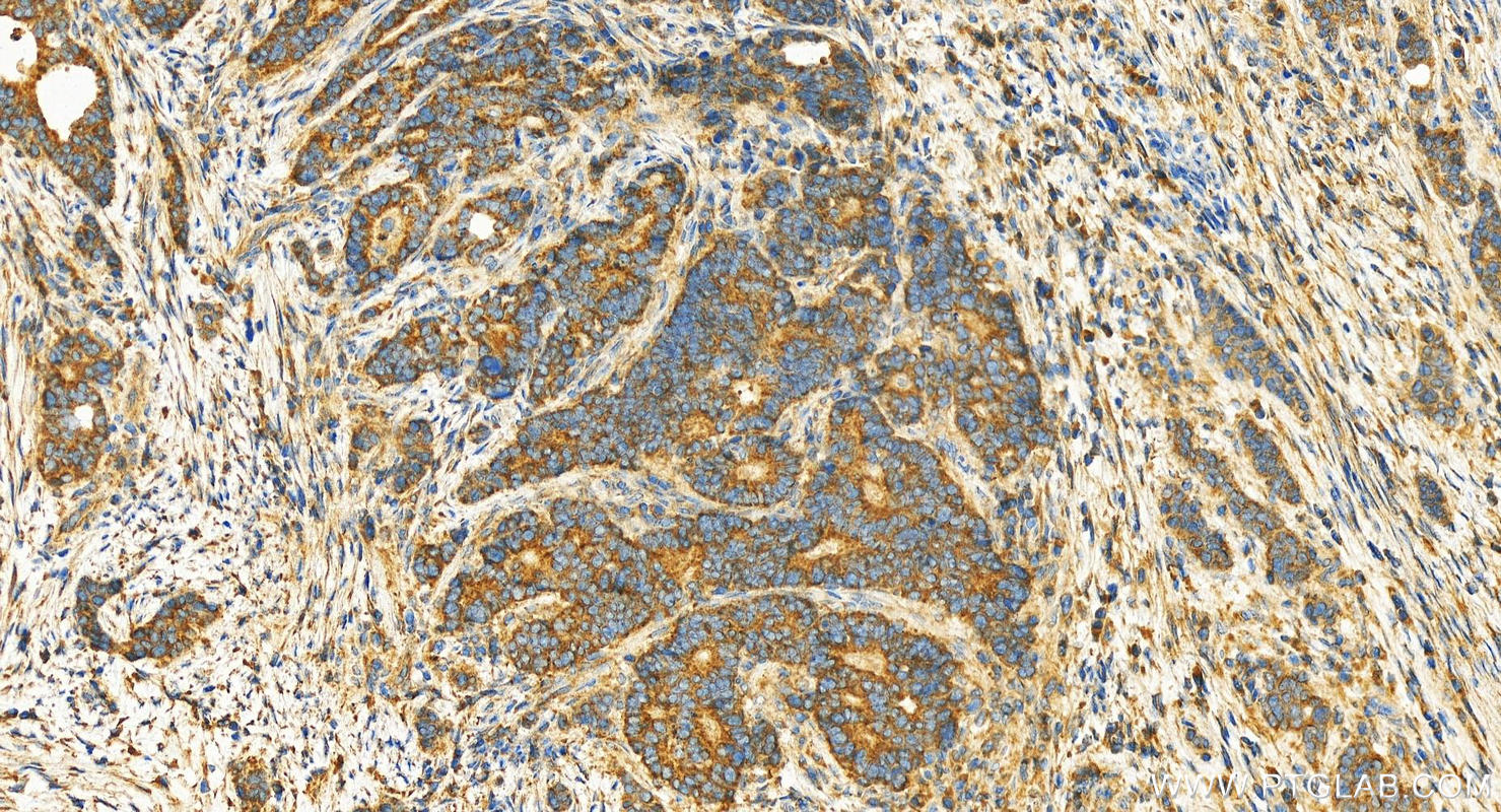 Immunohistochemistry (IHC) staining of human stomach cancer tissue using GULP1 Polyclonal antibody (19902-1-AP)