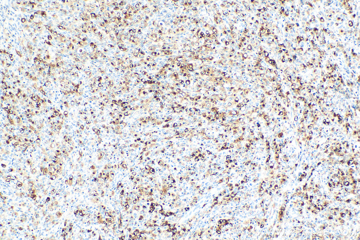 Immunohistochemistry (IHC) staining of human lymphoma tissue using Granzyme B Polyclonal antibody (31521-1-AP)