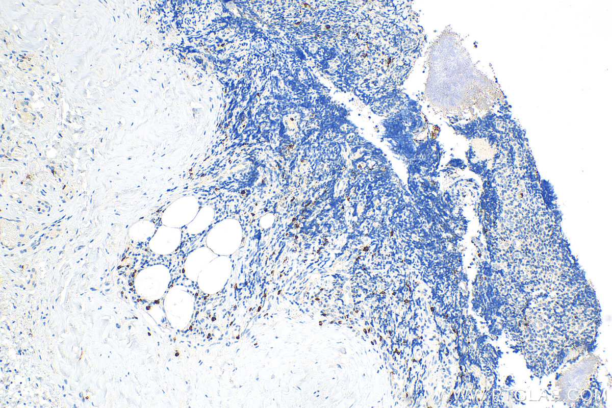 Immunohistochemistry (IHC) staining of human tonsillitis tissue using Granzyme B Polyclonal antibody (31521-1-AP)