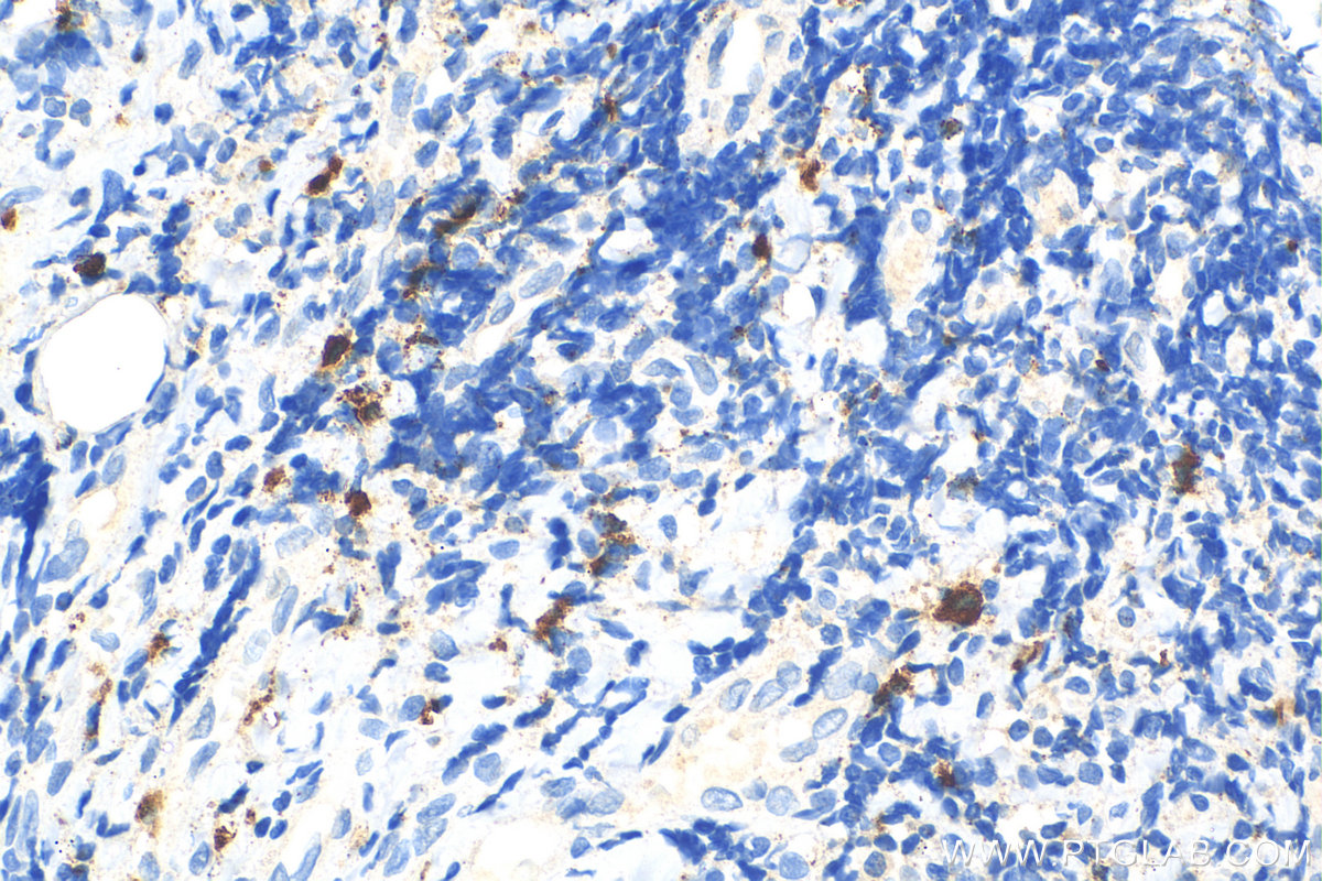 Immunohistochemistry (IHC) staining of human tonsillitis tissue using Granzyme B Polyclonal antibody (31521-1-AP)